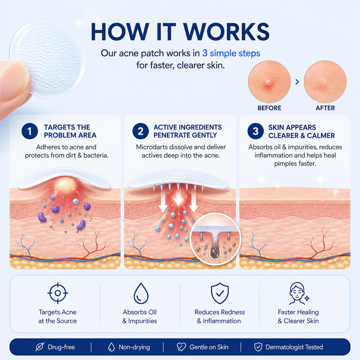 PimpleOut™ – Invisible Acne Patch